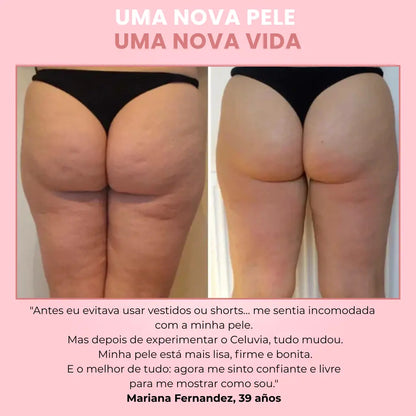 Celuvia™ Massageador Anticelulite